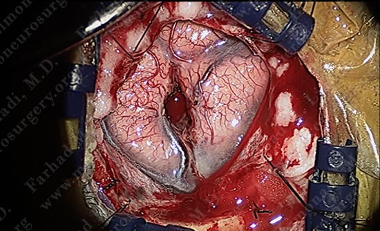 gbm-case10-011