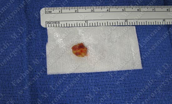gbm-case10-012