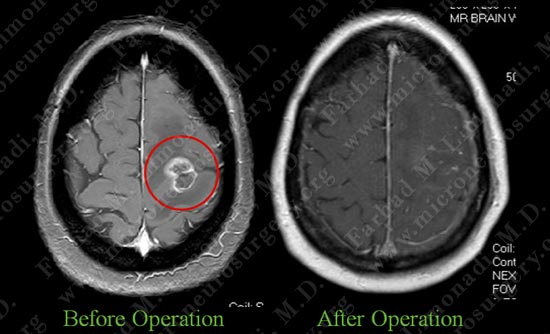 gbm-case10-014
