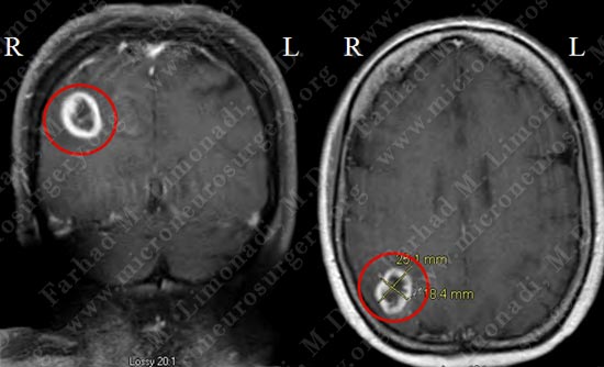 gbm-case11-001