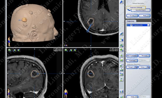 gbm-case11-002