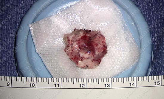 gbm-case11-003