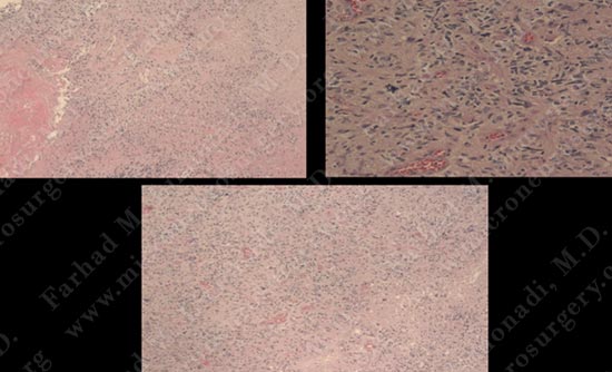 gbm-case11-004
