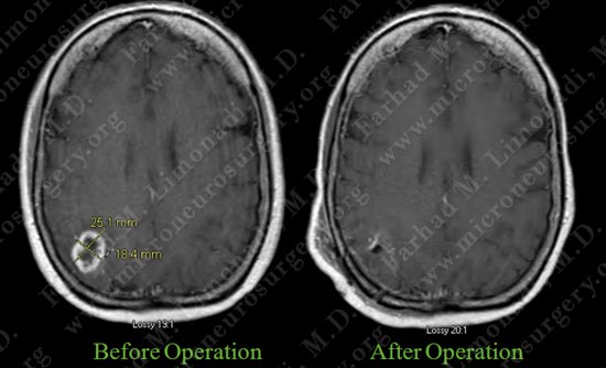 gbm-case11-005