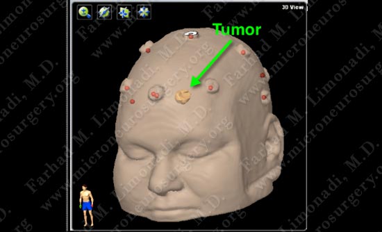 gbm-case12-002