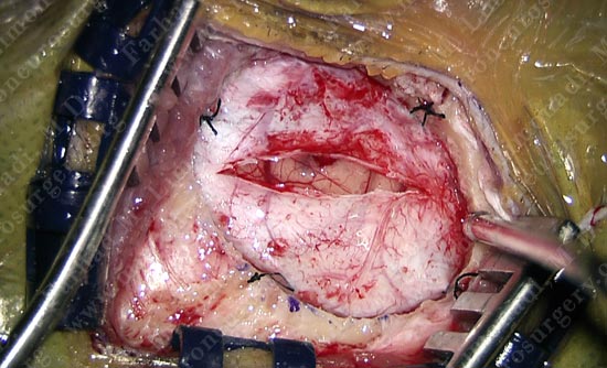 gbm-case12-003