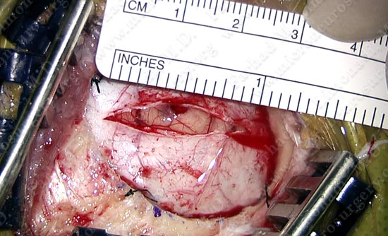 gbm-case12-004