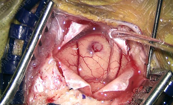 gbm-case12-005