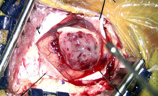 gbm-case12-006
