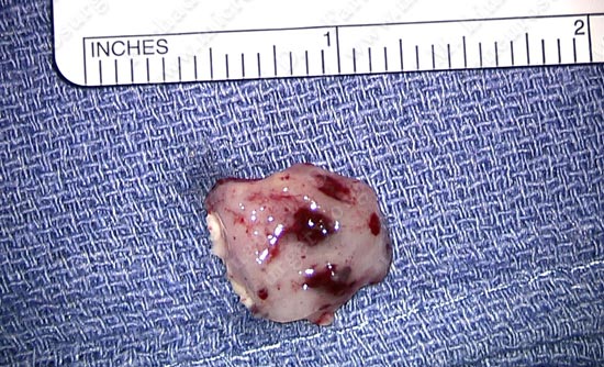 gbm-case12-007