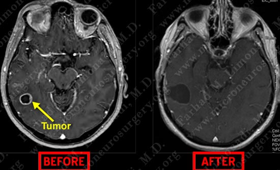 gbm-case12-009