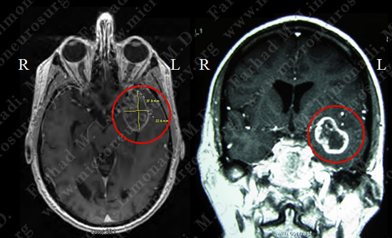 gbm case9 img1