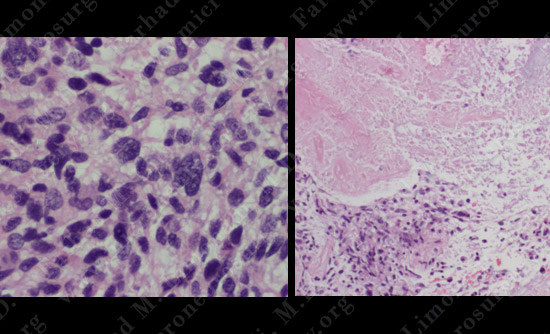 gbm case9 img10