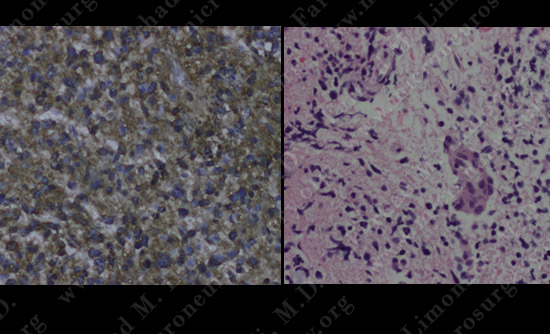 gbm case9 img11