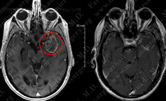 gbm case9 img12