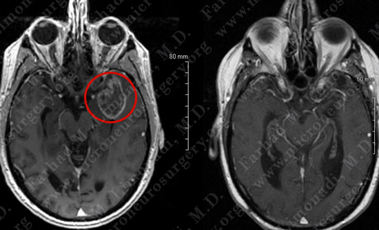 gbm case9 img13