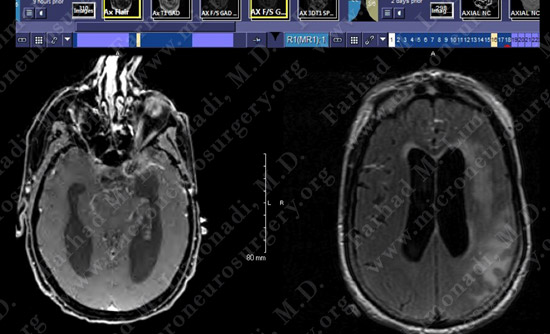 gbm case9 img15