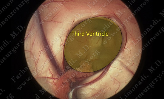 gbm case9 img17
