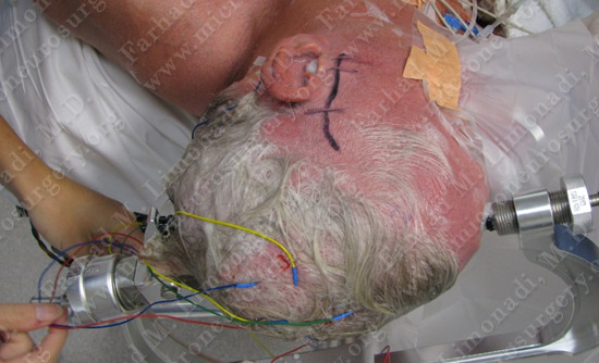 gbm case9 img3