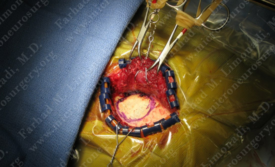 gbm case9 img4