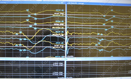 gbm case9 img6