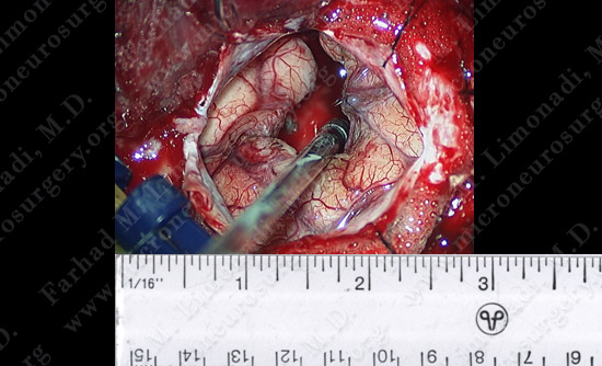 gbm case9 img9