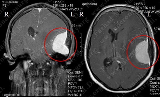 meningioma-case18-001