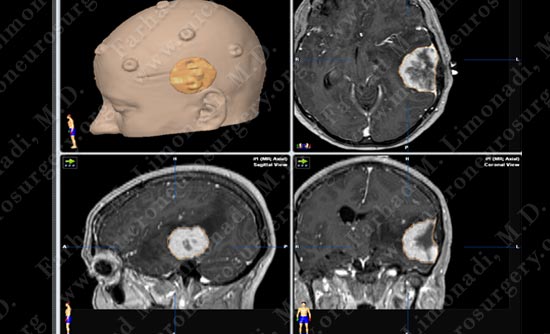 meningioma-case18-002
