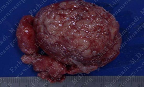 meningioma-case18-003