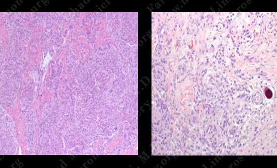 meningioma-case18-004