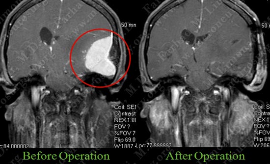 meningioma-case18-005