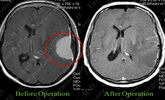 meningioma-case18-006
