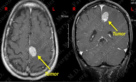 metastatic-case14-001