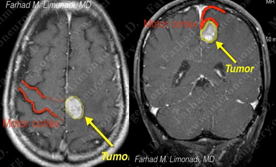 metastatic-case14-002