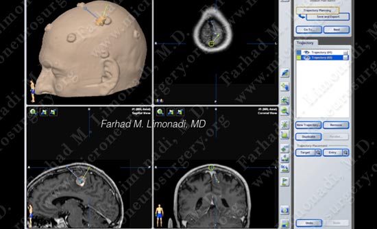 metastatic-case14-003