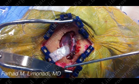 metastatic-case14-004