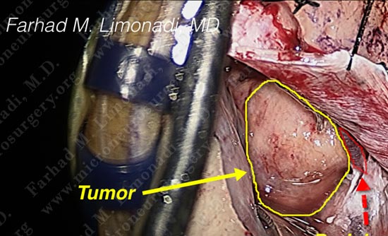 metastatic-case14-005