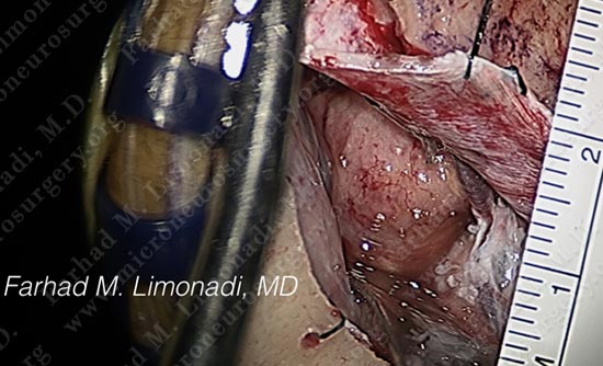 metastatic-case14-006