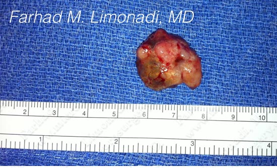 metastatic-case14-007