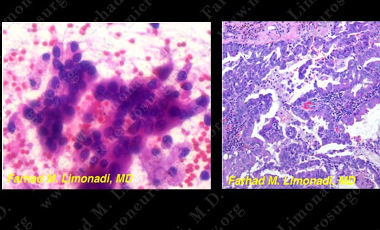 metastatic-case14-008