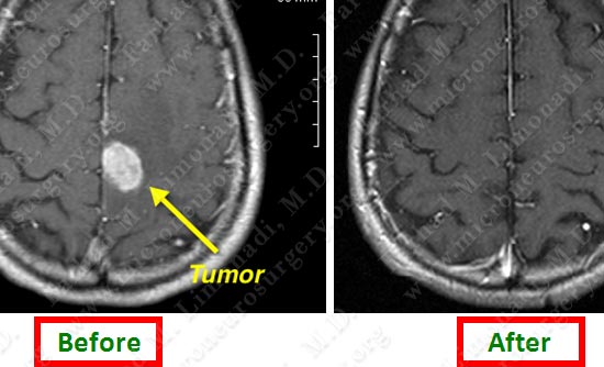 metastatic-case14-009