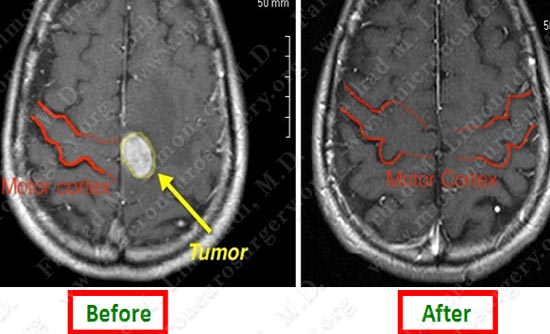 metastatic-case14-010