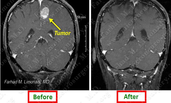 metastatic-case14-011