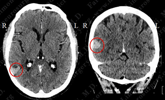 metastatic case10 img1
