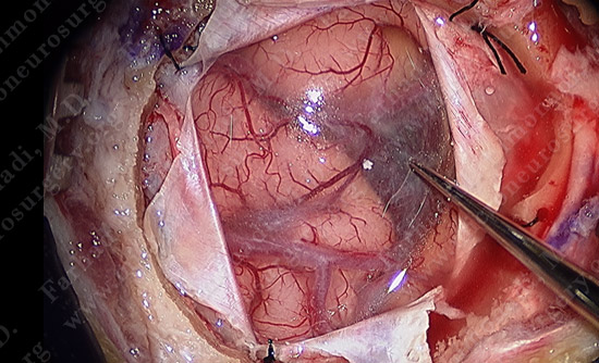 metastatic case10 img3