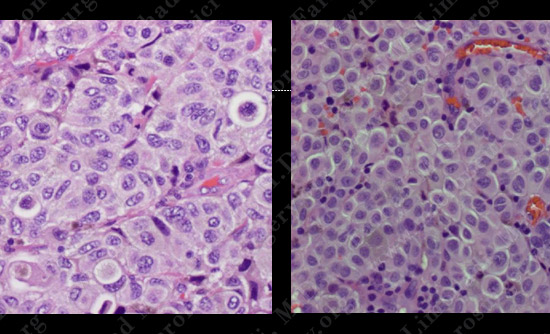 metastatic case10 img4