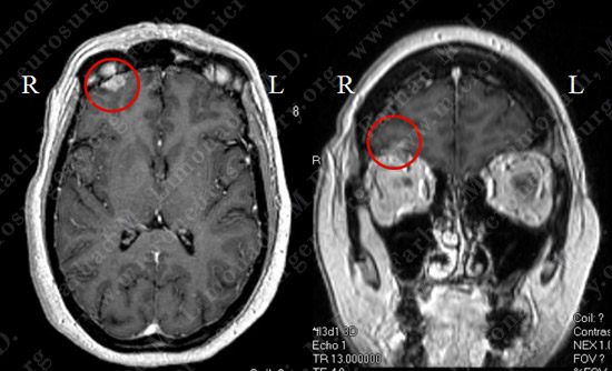 metastatic case11 img1