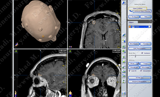 metastatic case11 img2