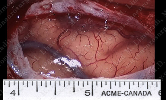 metastatic case11 img3