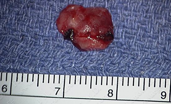metastatic case11 img4